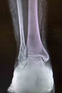 Ankle Pain Ankle Fracture