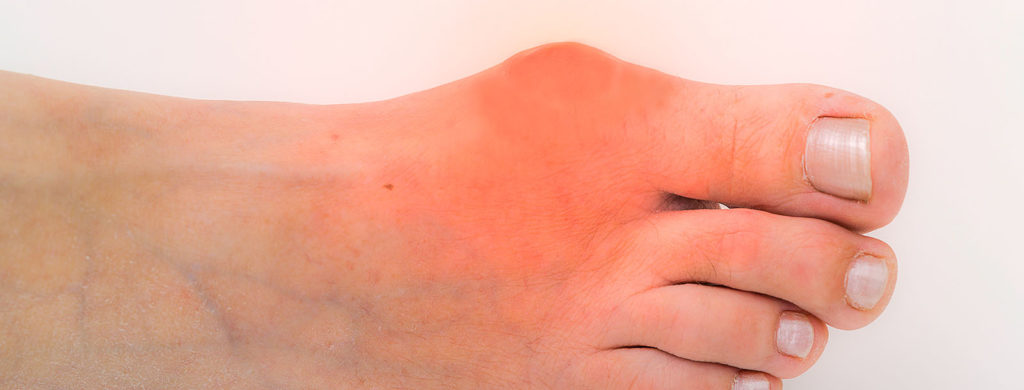 Gout Treatment And Gout Attack Pain Relief Northwest Indiana Podiatrist   Gout Attack Flare Up 1024x390 