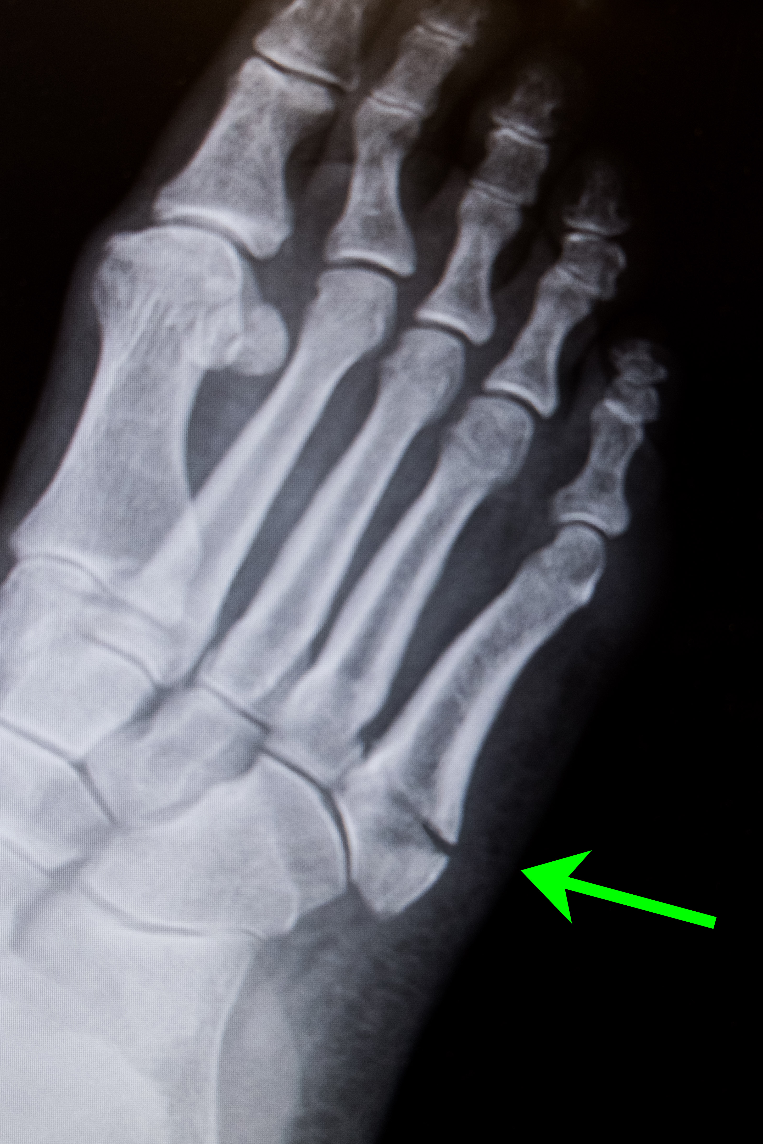 Foot Injury with Fracture - Friendly Footcare Inc.