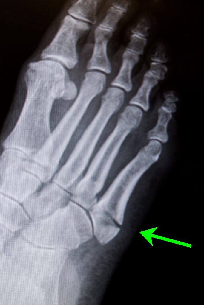 Metatarsal Fracture Foot - Friendly Foot Care PC